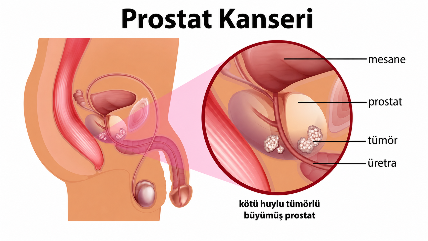 Prostat Kanseri